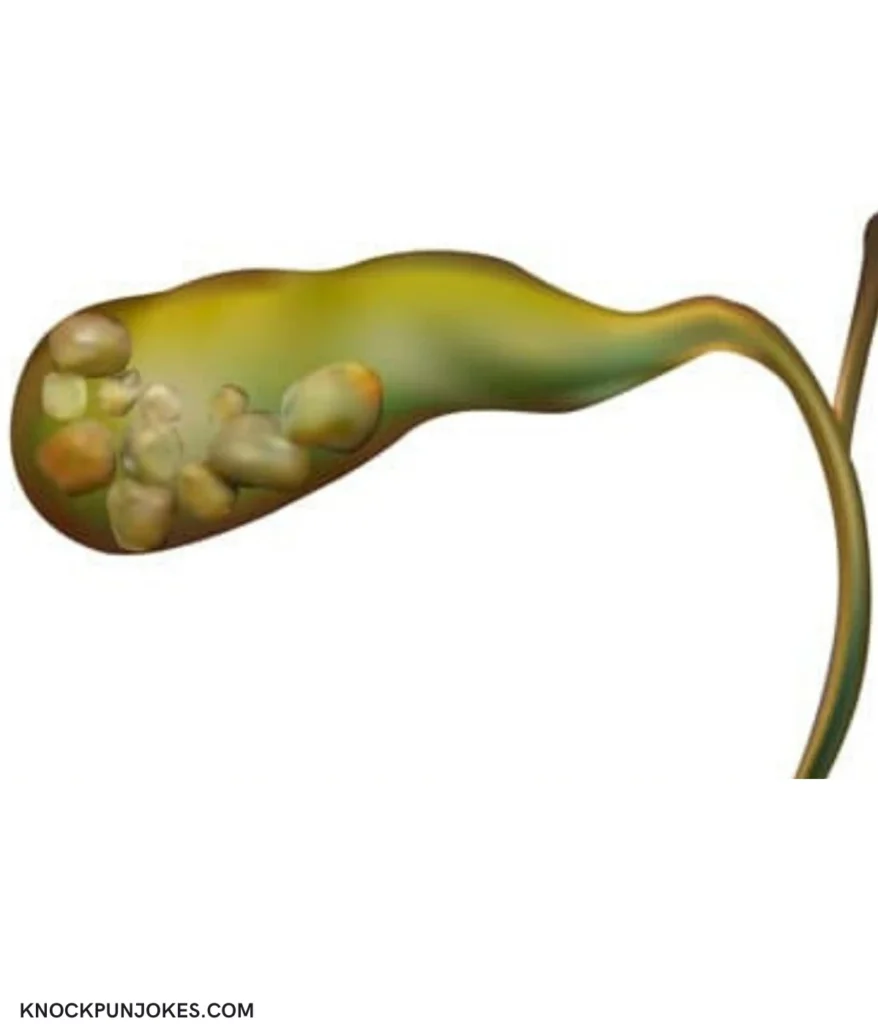gallstone-puns